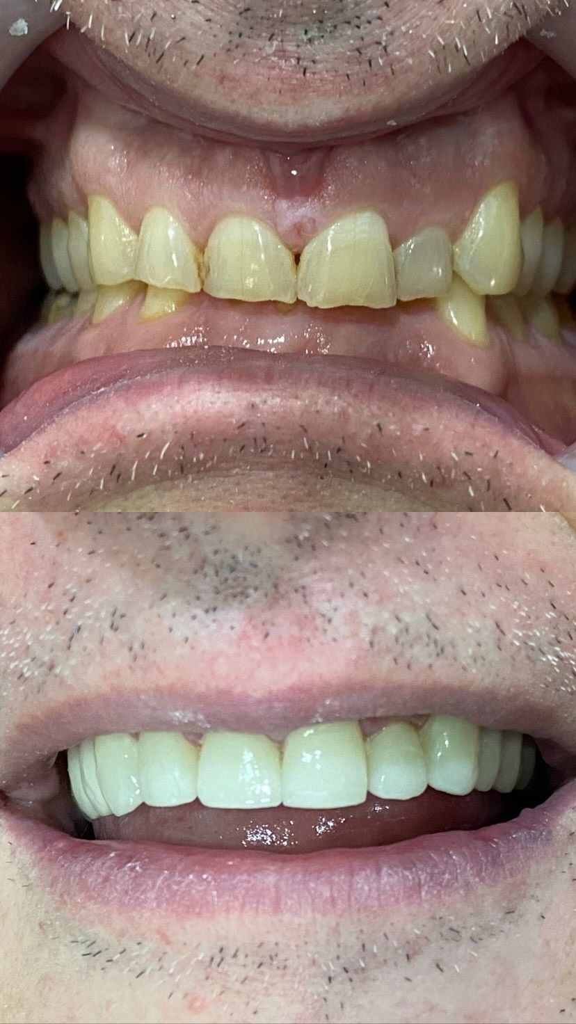 Porcelaine Veneer